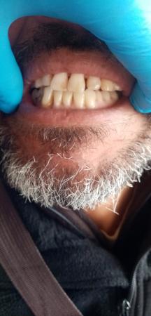 PRÓTESIS DENTALES ACRÍLICAS 