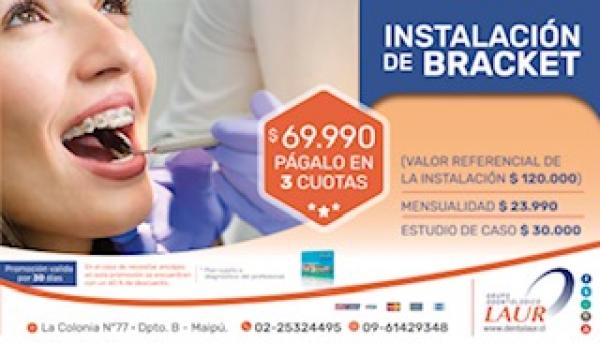 INSTALACIÓN DE BRACKET/ORTODONCIA